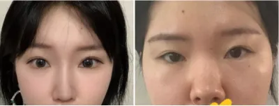 [Нүд] Бумбагар хамар - Нүд, хамар