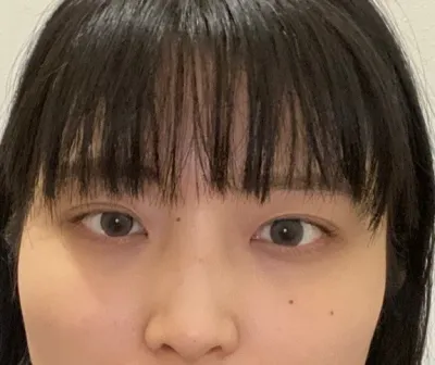 [Хамрын мэс засал] Бёлликаби - Нүд, хамар