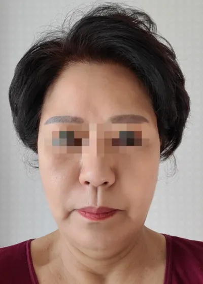 [Anti-Aging] Акация - Нүүр өргөх мэс засал