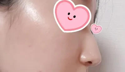 [Хамрын мэс засал] Бөмбөгөр хамар - Хамар