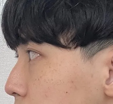 [Хамрын мэс засал] Hip Hinge - Хамар