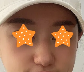 [Хамрын мэс засал] Хааааа - Хамар