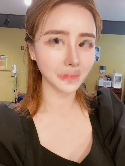 [Anti-aging] Асуулт асууж болно - Бүрэн нүүрний өөх шилжүүлэн суулгах, хамар