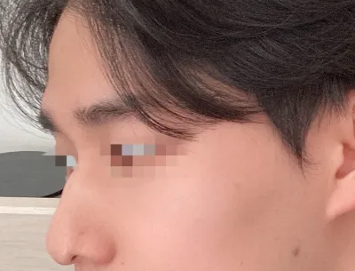 [Хамрын мэс засал] Куан И - Хамар