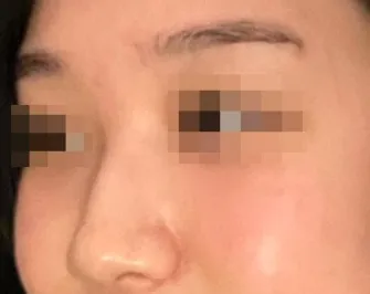 [Хамрын мэс ажилбар] Ханиаднаас болгоомжил - Хамар