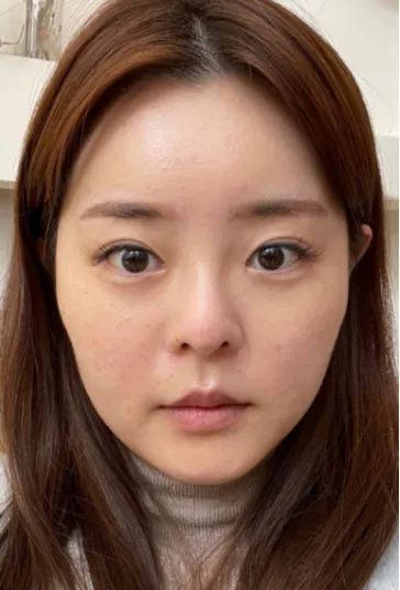 [Хамрын] МингАмингО - Нүд, Хамар, Нүүрний Өөх Соруулах