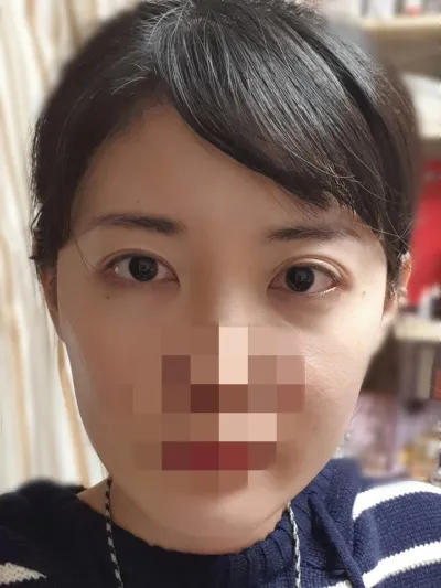 [Нүүрний хэлбэр засах мэс ажилбар] Дагина болчихлоо - Нүүрний хэлбэр, нүд