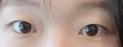 [Нүд] Давхар зовхигүйгээс далд давхар зовхитой болсон - Нүд