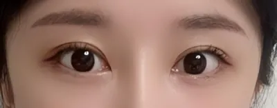 [Нүд] Нүдний мэс засал - Нүд