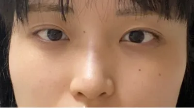 [Хамрын мэс засал] Төрфкүүкийк - Нүд, хамар