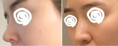 [Хамрын мэс засал] Кукудаззу - Хамар