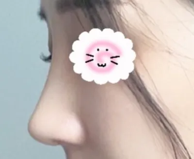 [Хамрын мэс засал] Муурын диваажин - Хамар