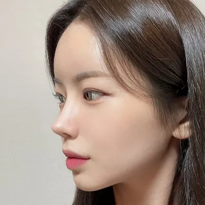 [Хамрын мэс засал] Диор - Хамрын үзүүр, хамрын нуруу, яс засах, бөхтэй хамар, муруй хамар