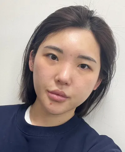 [Нүд] Тоор - Зүсэлгүйгээр зовхи засварлах (давтан хагалгаа), дээд зовхины өргөлт, доод зовхины өргөлт