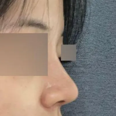 Виверс гоо сайхны мэс заслын хамрын мэс засал хийлгэснээс хойш 1 сарын дараах байдал