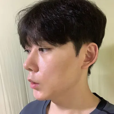 Би Вэберс гоо сайхны мэс заслын эмнэлгийн эмч Шим Жун Хванаар хамарны мэс засал хийлгэснээс хойш 2 долоо хоног болж байна.