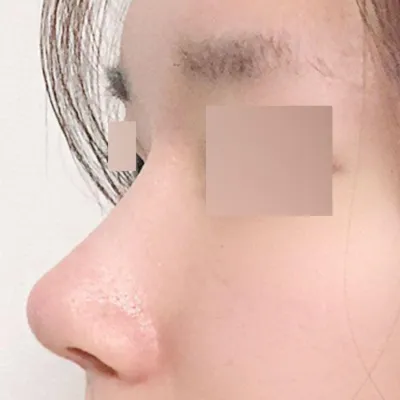 Жижиг, дарагдсан бөгтөр хамартай мэс заслын дараах нэг сарын тойм