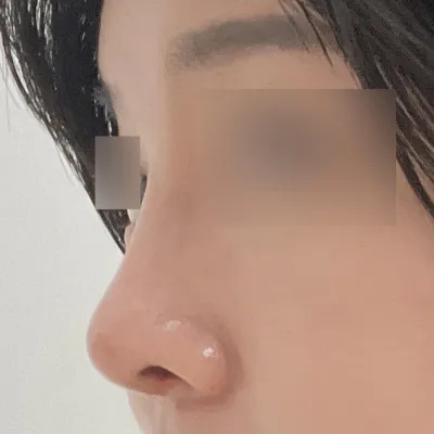 Би хамар томсгох мэс засал хийлгэсэн~! 