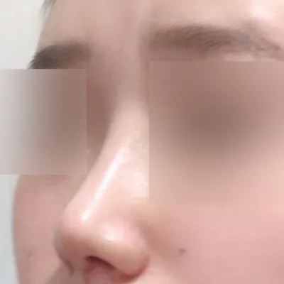 Хамрын дахин мэс засал хийлгэснээс хойш хоёр сар боллоо