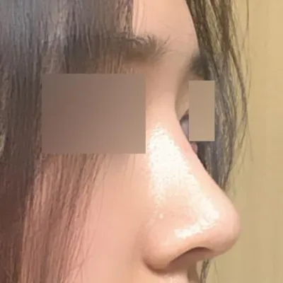 Тэгш бус, төмрөг хамар засварлуулсан