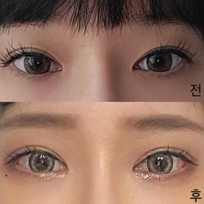 Нүдний дахин хагалгаанд ороод аль хэдийн хоёр сар орчим болжээㅎ