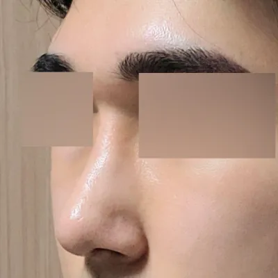 Хамрын мэс заслын дараах нэг сарын тойм