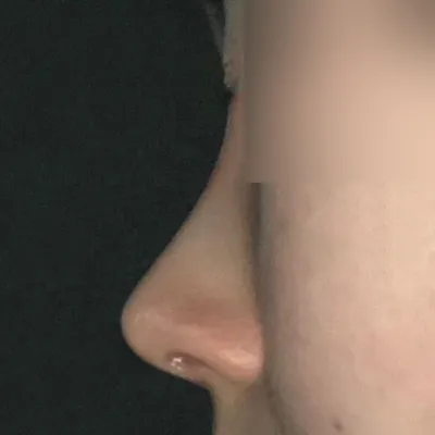 Би Вэверс гоо сайхны мэс заслын эмнэлгийн дарга Со Сын Жо-д хамраа мэс засалд оруулснаас хойш 1 сар болж байна!