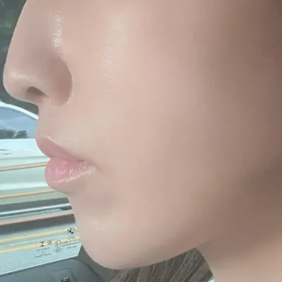 Намайг зовоож байсан хамар уруулын атирааг сайжруулсан!