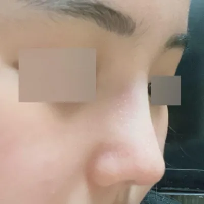 Богино хамартай + үйл ажиллагааны хамар заслын 2 сар