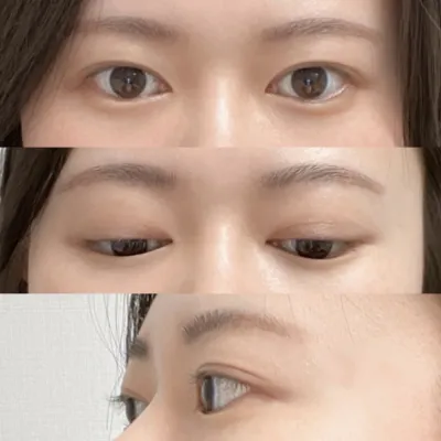 Булаг, Нүдний хэлбэр засах мэс заслын тойм