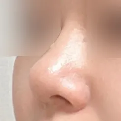 Имплантгүй хамар засах мэс заслын тойм