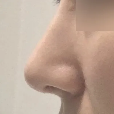 Хамрын мэс засал хийлгэснээс хойш бараг 4 сар болж байна