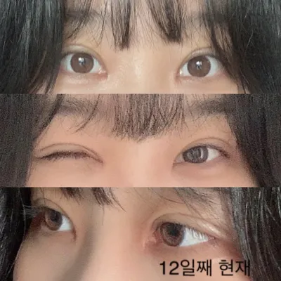 Нүдний давхар мэс заслын үр дүнд үнэхээр сэтгэл хангалуун байгаа тухай жинхэнэ сэтгэгдэл