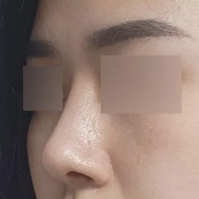 Жижигхэн булцгар хамар засч, 2 сар боллоо!