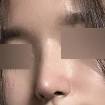 Шулуун шугамаар мэс засал хийлгэснээс хойш 2 сар боллоо