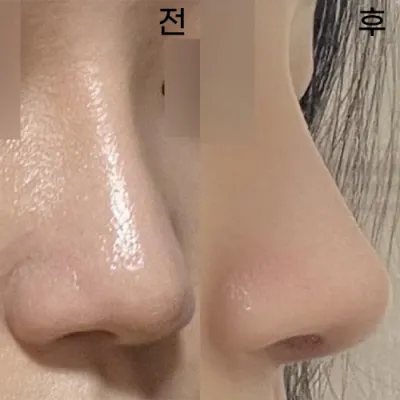 Төлөөлөх эмчээс хамрын дахин мэс засал хийлгэснээс хойш сар гаруй хугацаа өнгөрчээ