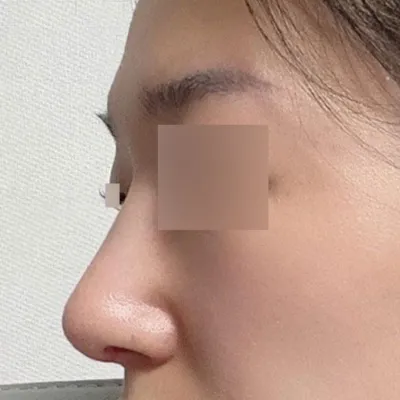 Би хамарны бөх мөрийг протезгүйгээр авахуулсан!