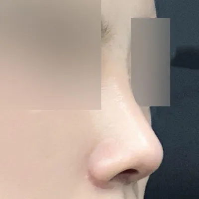 Хамрын мэс засал хийлгээд сар боллоо!