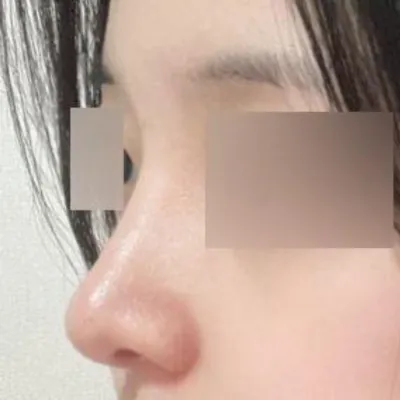 Би Веверсээс мэс ажилбар хийлгээд 3 сар болжээ хэхэ