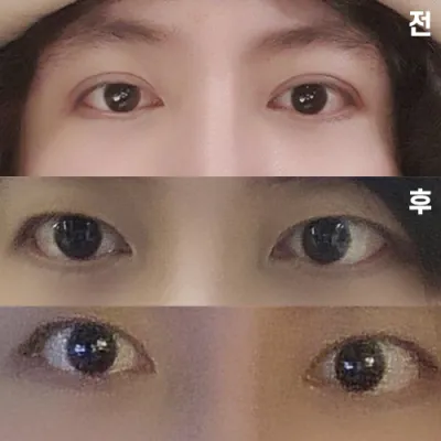 Давхар зураас багасгах мэс заслын дараах төлөв байдал