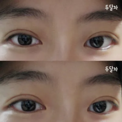 Нүдний мэс заслын дараах 2 сарын бодит сэтгэгдэл~^^