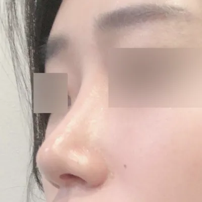 Хамрын үзүүрийг өргөх мэс засал хийлгэснээс хойш 3 сар боллоо !!!