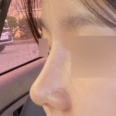 Хамар томруулах мэс засал хийлгэснээс хойш 3 сар боллоо