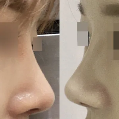 Хамрын мэс засал хийлгэснээс хойш 3 сар өнгөрчээ