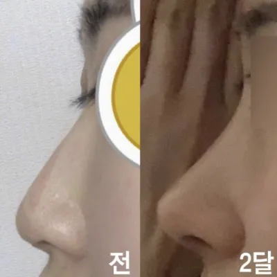 Эрэгтэйлэг харагддаг бөгтрөг хамартай байсныг засаж, илүү чамин харагдах болсон!