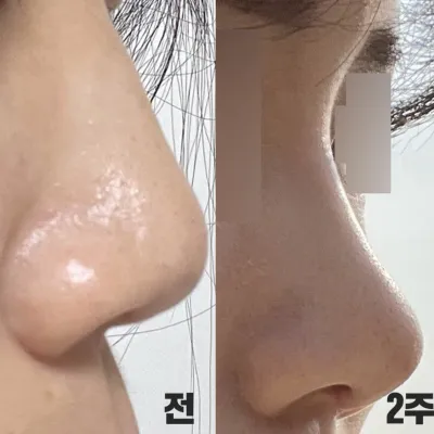 Хамрын мэс засалд ороод сар боллоо!