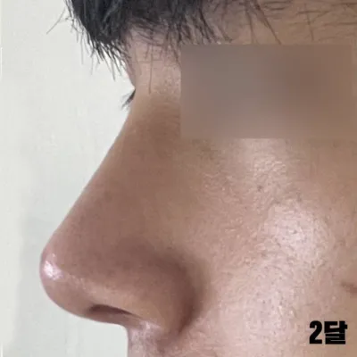 Мэс ажилбарын үеэр хамар жижигсгэх мэс ажилбар хийлгэсэн, сэтгэл хангалуун байна.