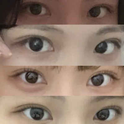 (Байгалийн наалдацтай нүдний хэлбэр засах урд зүсэлт) хагалгаанд орсны дараах 4 сар