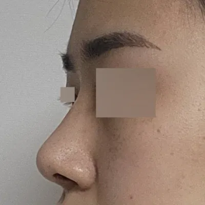 Мэс засал хийлгэснээс хойш 3 сар болж байна.