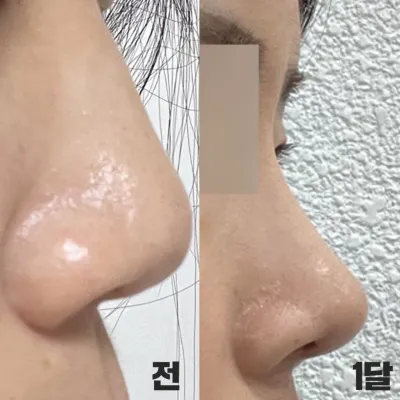 Шулуун мэдрэмжтэй хамрын мэс засал хийлгэснээс хойш нэг сар